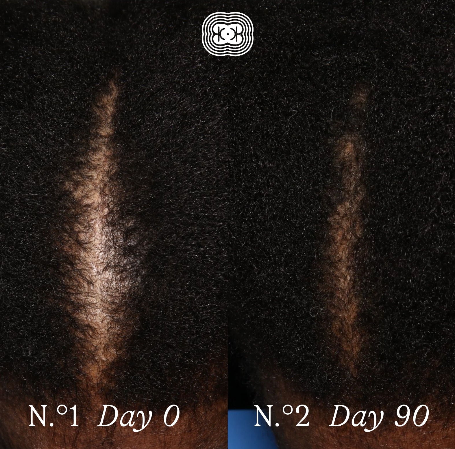 The Hair Density Ritual - The Ultimate 5-Step Renewal